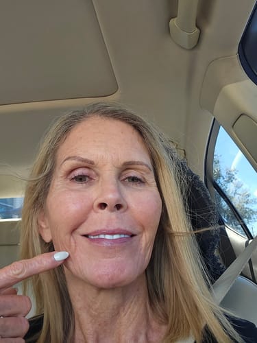 Reviewer pointing to their cheek to show results after using the Seranova Micro Infusion System.